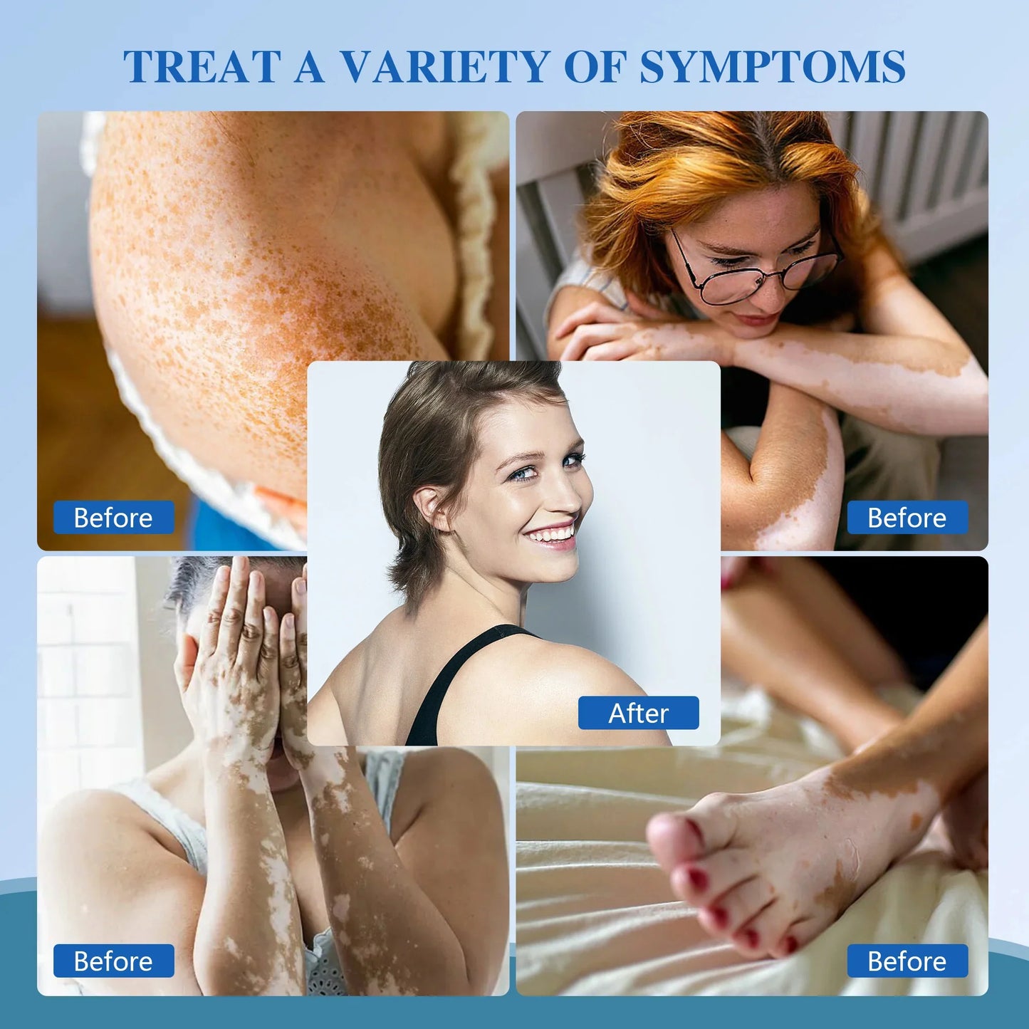 Handheld UVB Phototherapy Device for Vitiligo & Psoriasis - Portable 308nm Light Therapy Lamp by UVBtreatment⏳Limited-time 49% off⏰💥