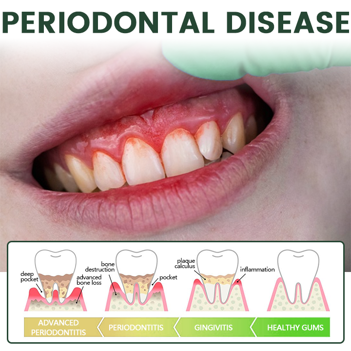 🦷Timilk® WillowBark Tooth Spray🛡️🌿 Multi-Repair for Dental problems🦷