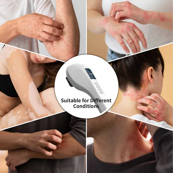 Handheld UVB Phototherapy Device for Vitiligo & Psoriasis - Portable 308nm Light Therapy Lamp by UVBtreatment⏳Limited-time 49% off⏰💥