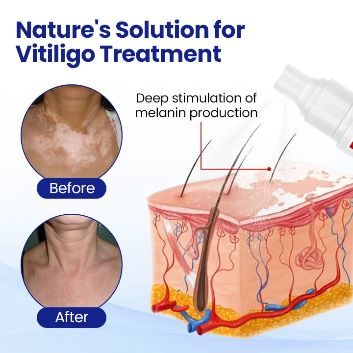 LAOZIK™ Vitiligo Treatment Spray🔥The FDA-Approved Solution🌟 Official Store