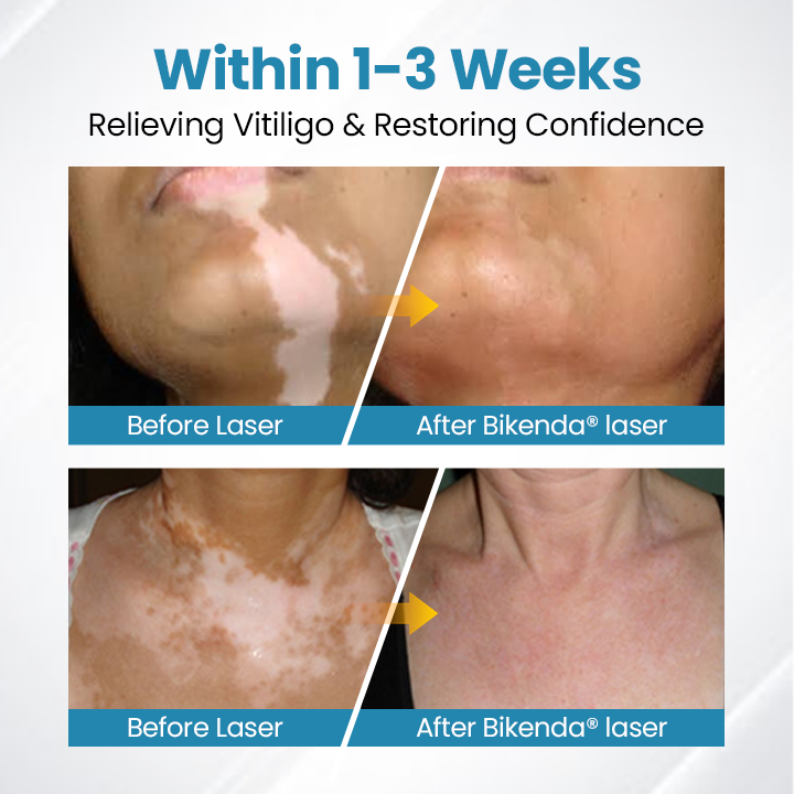 Bikenda® DermaBeam Vitiligo Therapy Device⏳Limited-time 49% off⏰💥