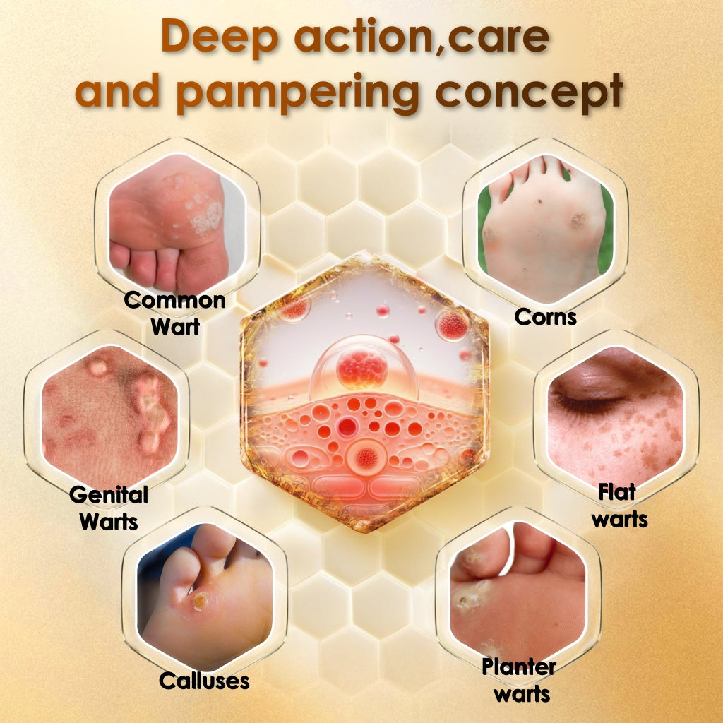 👓Best Selling 48% Off🔥Bee Venom Corn & Callus Remover Cream