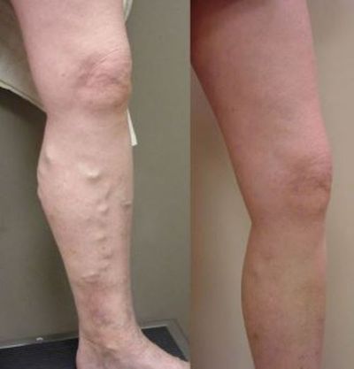 🔥LAOZIK™VARICOSE VEINS RELIEF PATCHES