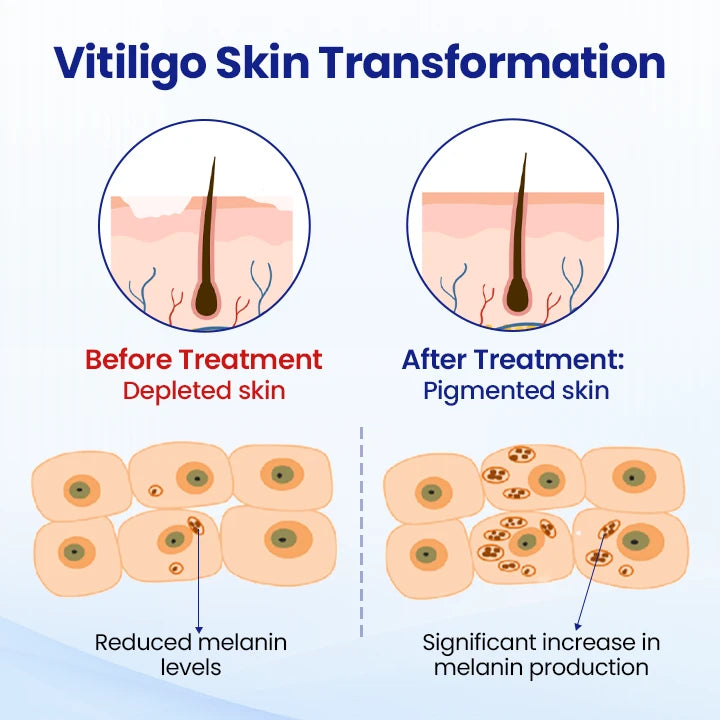 LAOZIK™ Vitiligo Treatment Spray🔥The FDA-Approved Solution🌟 Official Store