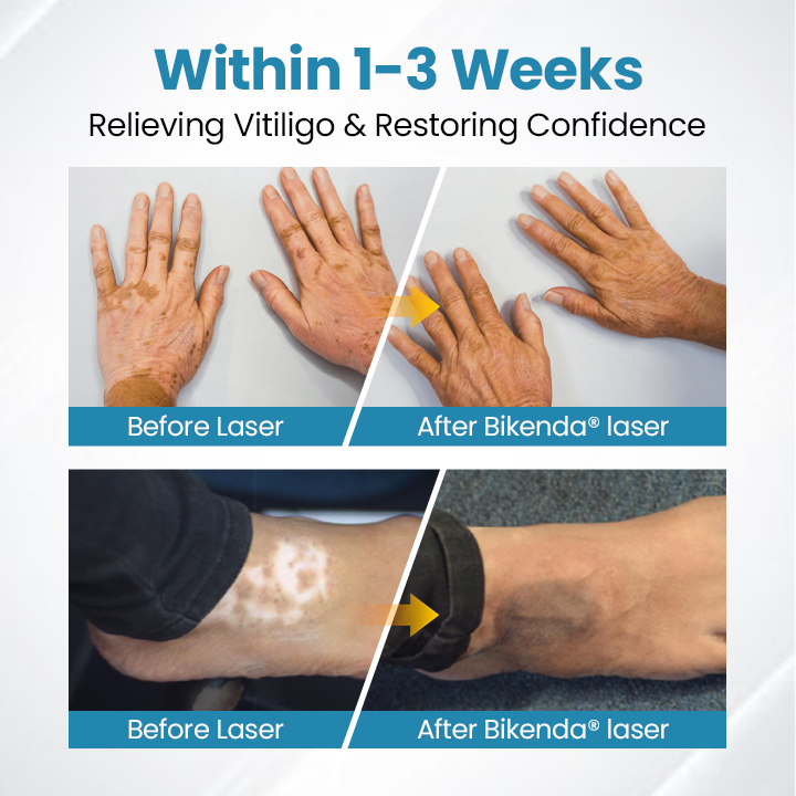 Bikenda® DermaBeam Vitiligo Therapy Device⏳Limited-time 49% off⏰💥