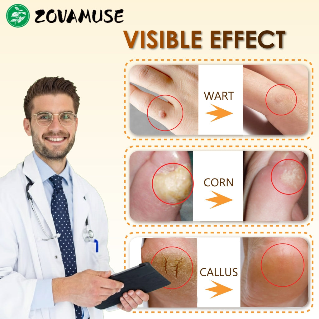 👓Best Selling 48% Off🔥Bee Venom Corn & Callus Remover Cream