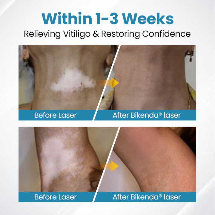 Bikenda® DermaBeam Vitiligo Therapy Device⏳Limited-time 49% off⏰💥