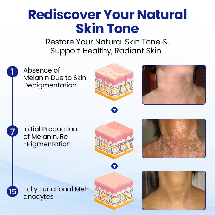 LAOZIK™ Vitiligo Treatment Spray🔥The FDA-Approved Solution🌟 Official Store