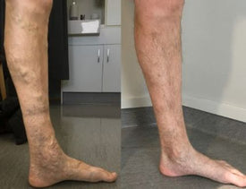 🔥LAOZIK™VARICOSE VEINS RELIEF PATCHES