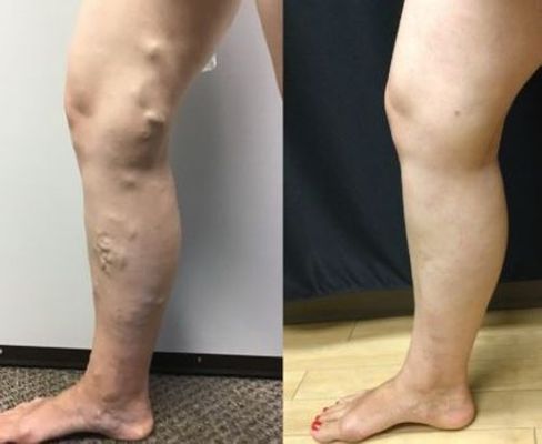 🔥LAOZIK™VARICOSE VEINS RELIEF PATCHES