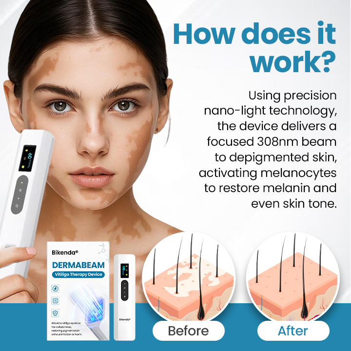 Bikenda® DermaBeam Vitiligo Therapy Device⏳Limited-time 49% off⏰💥