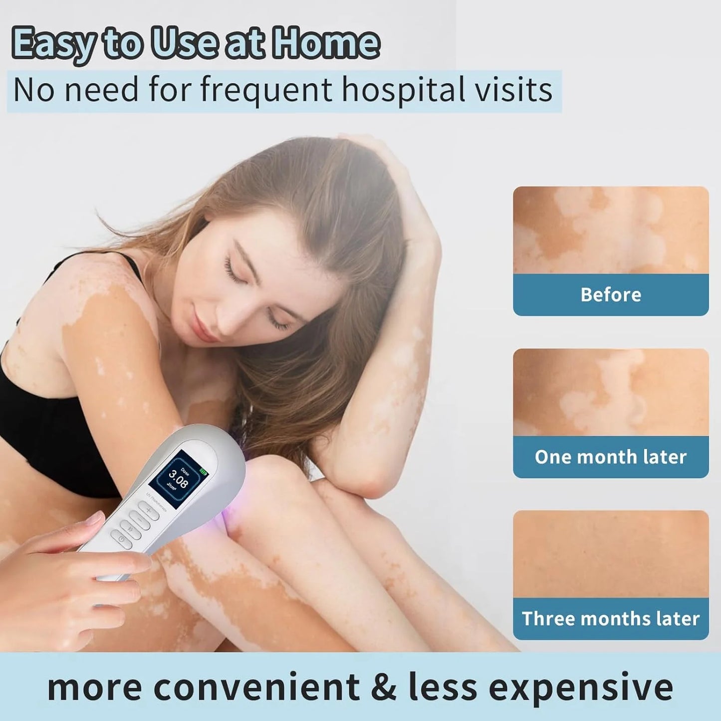 Handheld UVB Phototherapy Device for Vitiligo & Psoriasis - Portable 308nm Light Therapy Lamp by UVBtreatment⏳Limited-time 49% off⏰💥